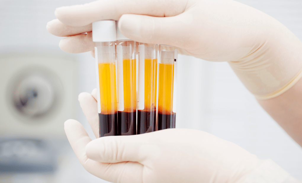 Bloedplaatjesrijk plasma voor PRP-therapie bij artrose
